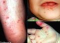 BỆNH TAY CHÂN MIỆNG: CHẨN ĐOÁN, CÁCH ĐIỀU TRỊ VÀ PHÒNG BỆNH