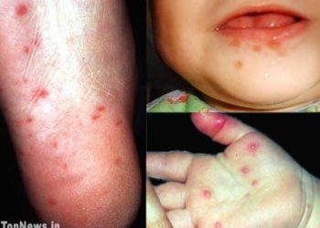 BỆNH TAY CHÂN MIỆNG: CHẨN ĐOÁN, CÁCH ĐIỀU TRỊ VÀ PHÒNG BỆNH