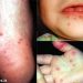 BỆNH TAY CHÂN MIỆNG: CHẨN ĐOÁN, CÁCH ĐIỀU TRỊ VÀ PHÒNG BỆNH