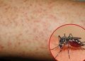 QUY TRÌNH KỸ THUẬT  THỰC HIỆN NGHIỆM PHÁP DÂY THẮT  TRONG CHĂM SÓC SỐT XUẤT HUYẾT DENGUE