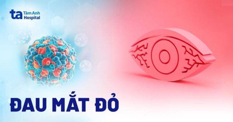BỆNH ĐAU MẮT ĐỎ