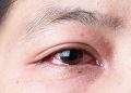 Bệnh Đau Mắt Đỏ